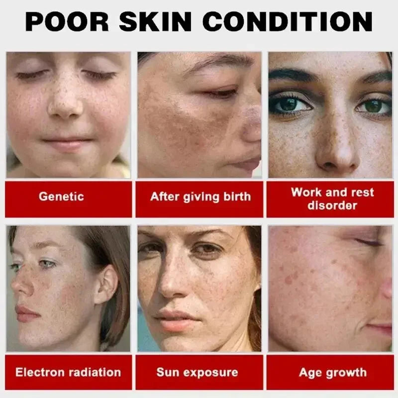 Whitening Freckles Face Cream Removal