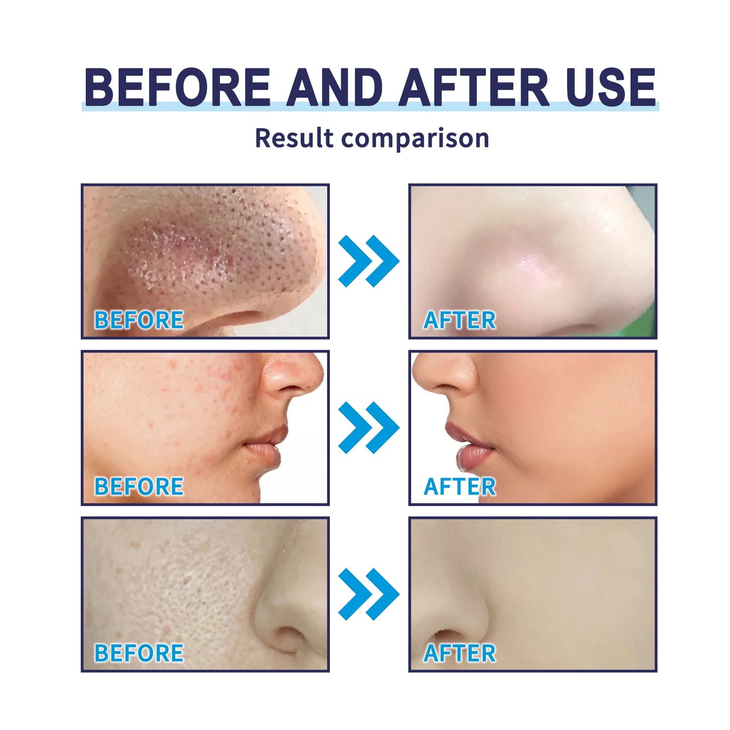 Blackhead mask acne deep cleansing