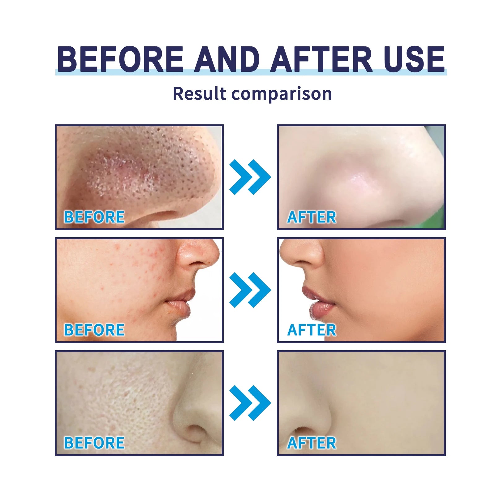 Blackhead mask acne deep cleansing - Stylish Expression