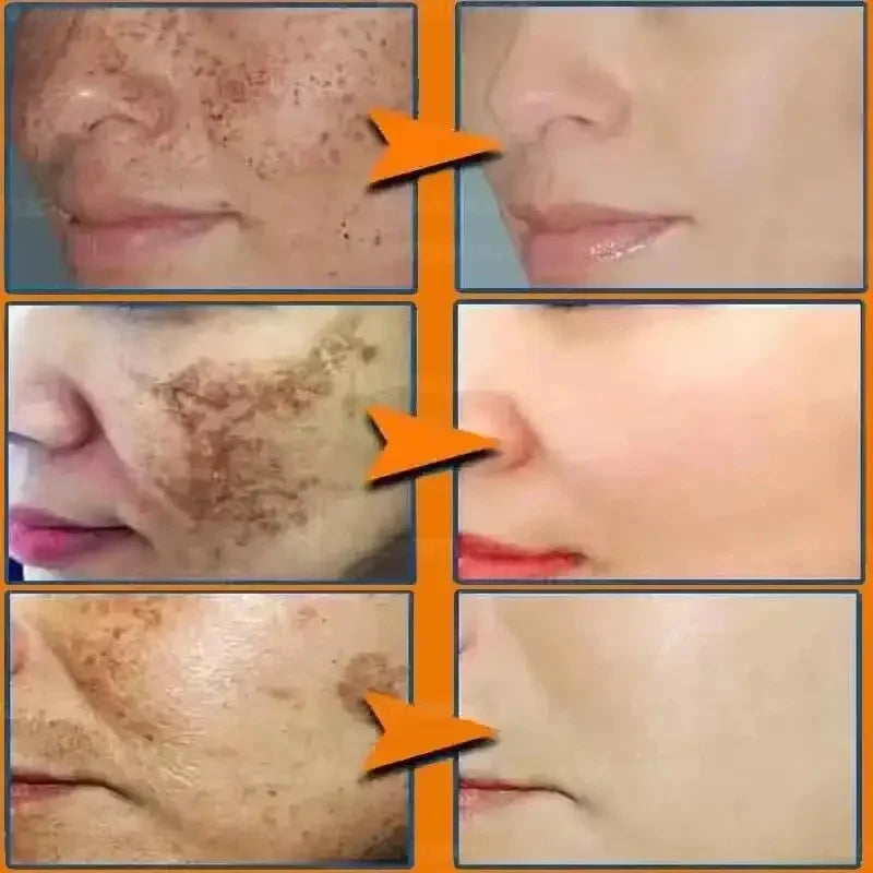 Whitening Freckles Face Cream Removal - Stylish Expression