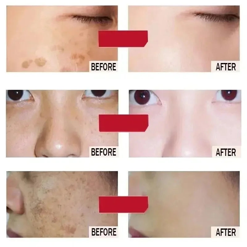 Whitening Freckles Face Cream Removal - Stylish Expression