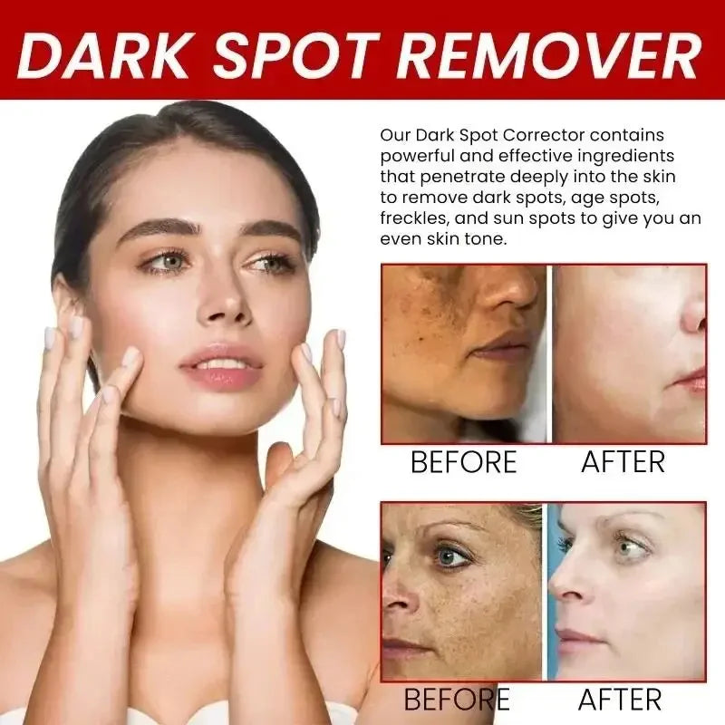 Whitening Freckles Face Cream Removal - Stylish Expression