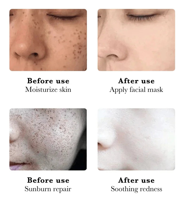 Whitening Freckles Face Cream Removal