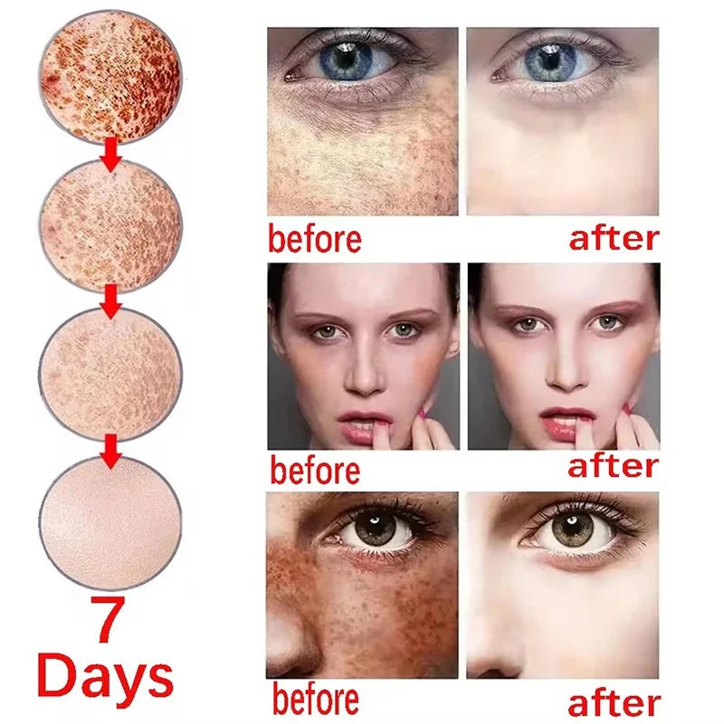 Whitening Freckles Face Cream Removal - Stylish Expression