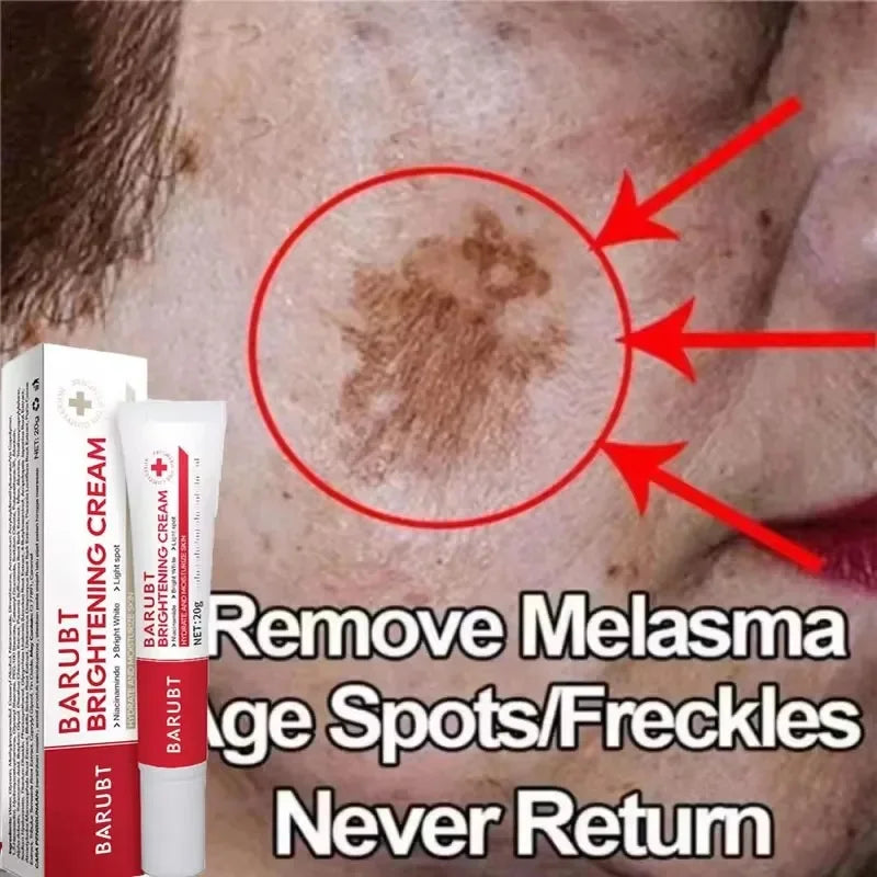 Whitening Freckles Face Cream Removal - Stylish Expression