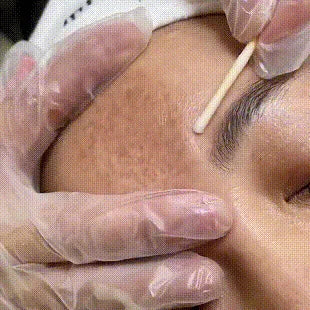 Whitening Freckles Face Cream Removal