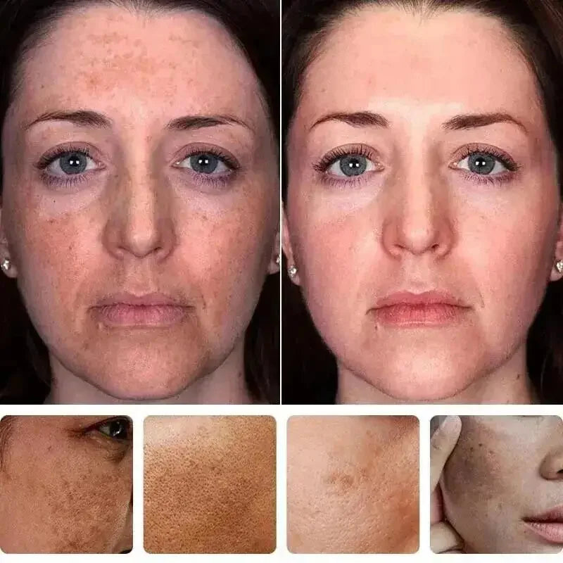 Whitening Freckles Face Cream Removal