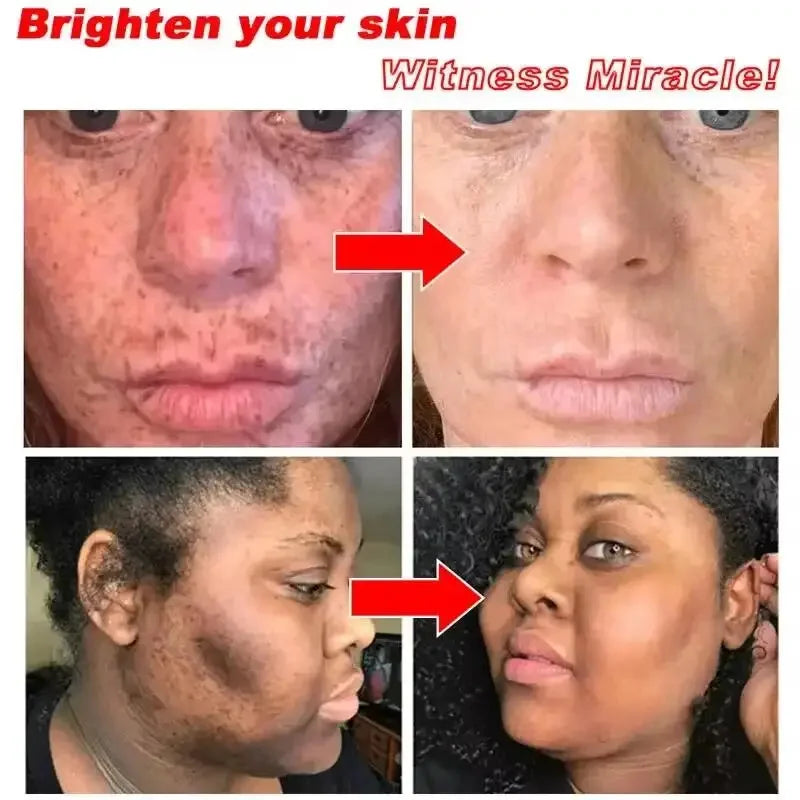 Whitening Freckles Face Cream Removal