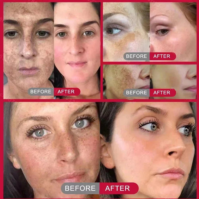 Whitening Freckles Face Cream Removal - Stylish Expression