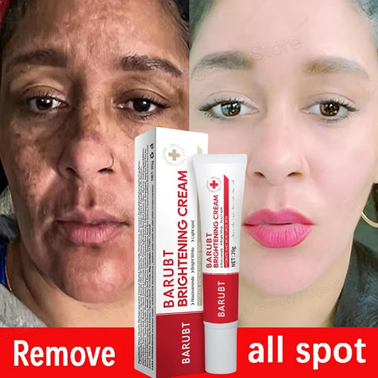 Whitening Freckles Face Cream Removal